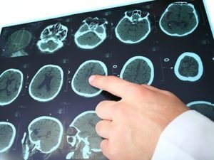 Лекарство от аллергии поможет людям с рассеянным склерозом