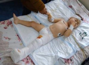 Раненую во время обстрела Мартуни двухлетнюю Арцвик прооперировали