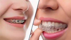 Капы для выравнивания зубов: виды