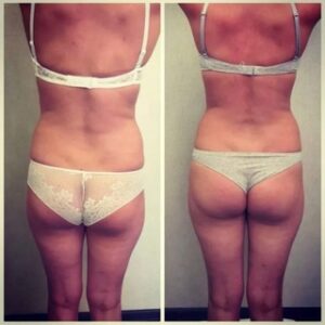 Эффективность LPG массажа