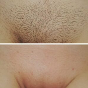 Как часто нужно делать лазерную эпиляцию?