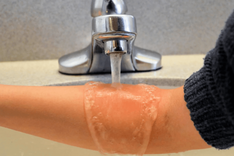 Как лечить ожоги от масла