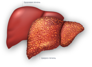Как лечится цирроз?