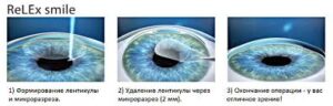 Лазерная коррекция зрения Relex Smile: плюсы и особенности