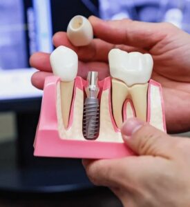 Имплантация зубов «под ключ»: комплексное решение для восстановления зубного ряда