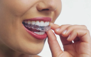 Элайнеры Invisalign: невидимая альтернатива брекетам для идеальной улыбки
