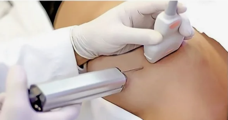 Пункция молочной железы под контролем УЗИ: особенности процедуры и показания