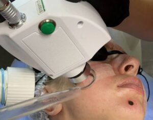 Что входит в стоимость лазерной шлифовке лица