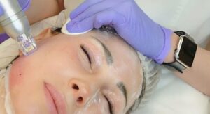 Микроигольчатый RF-лифтинг: инновационный метод омоложения кожи