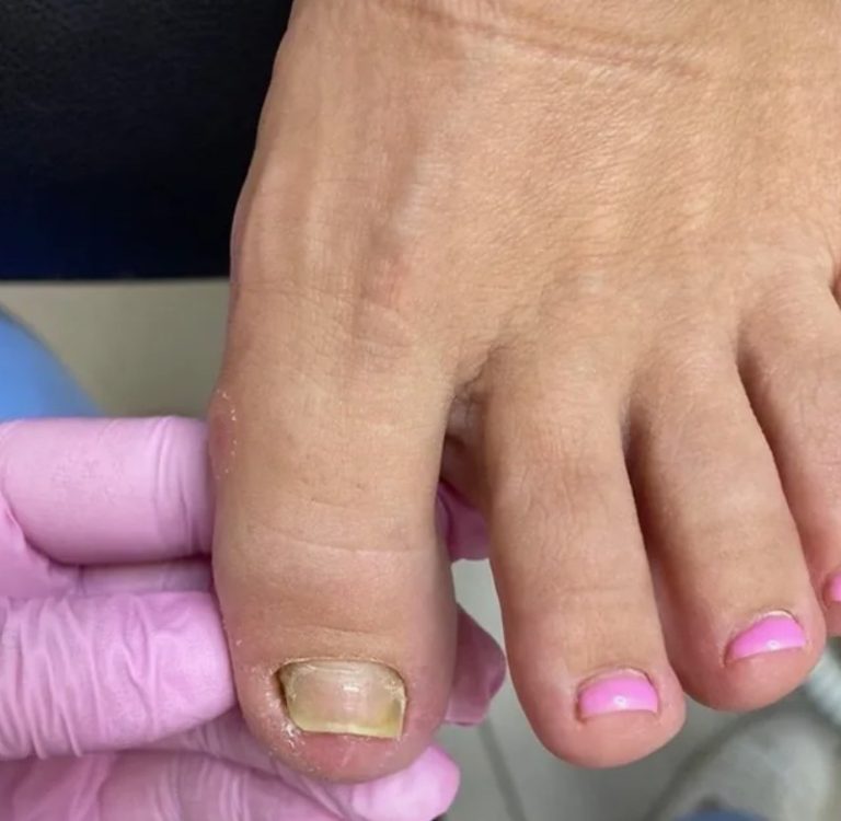 Удаление экзостоза