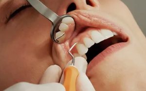 Комплексное лечение заболеваний десен: от диагностики до полного выздоровления