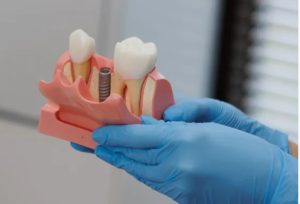 Процедура имплантации зубов в Туле в стоматологии Денттайм